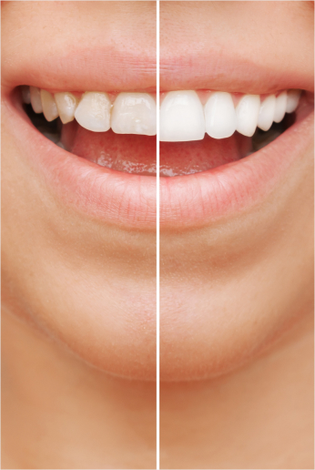 Close Up Of Before And After Smile