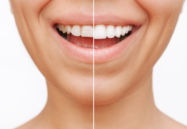 Before and after picture of a patient’s smile before and after cosmetic bonding